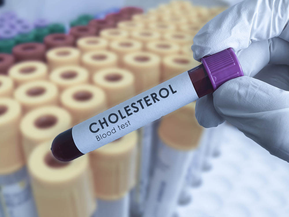 Understanding the Importance of Regular Cholesterol Testing