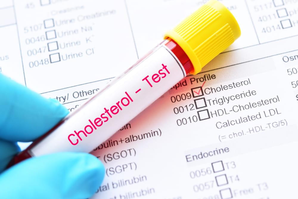 Is Fasting Necessary Before a Cholesterol Test?